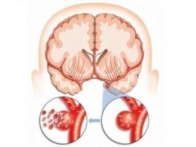Геморрагический инсульт